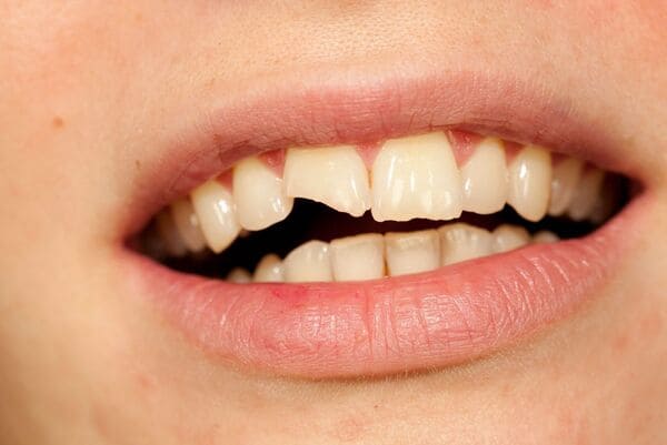 How Mouthguards Protect Your Teeth from Chips and Cracks