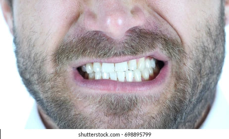 Custom Mouthguards for Teeth Grinding and Bruxism