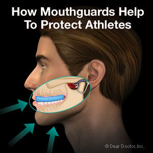 How Mouthguards Prevent Concussions and Brain Injuries: A Closer Look