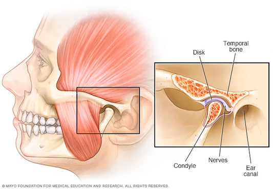 The Role of Mouthguards in Preventing TMJ Disorders