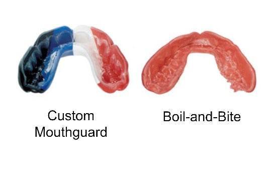 Why Custom Mouthguards Outperform Boil-and-Bit